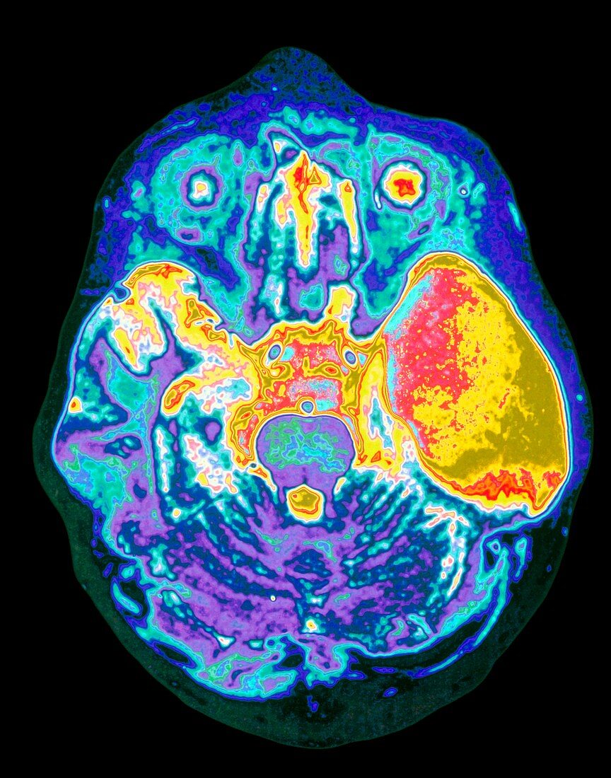 Coloured MRI brain scan showing an arachnoid cyst