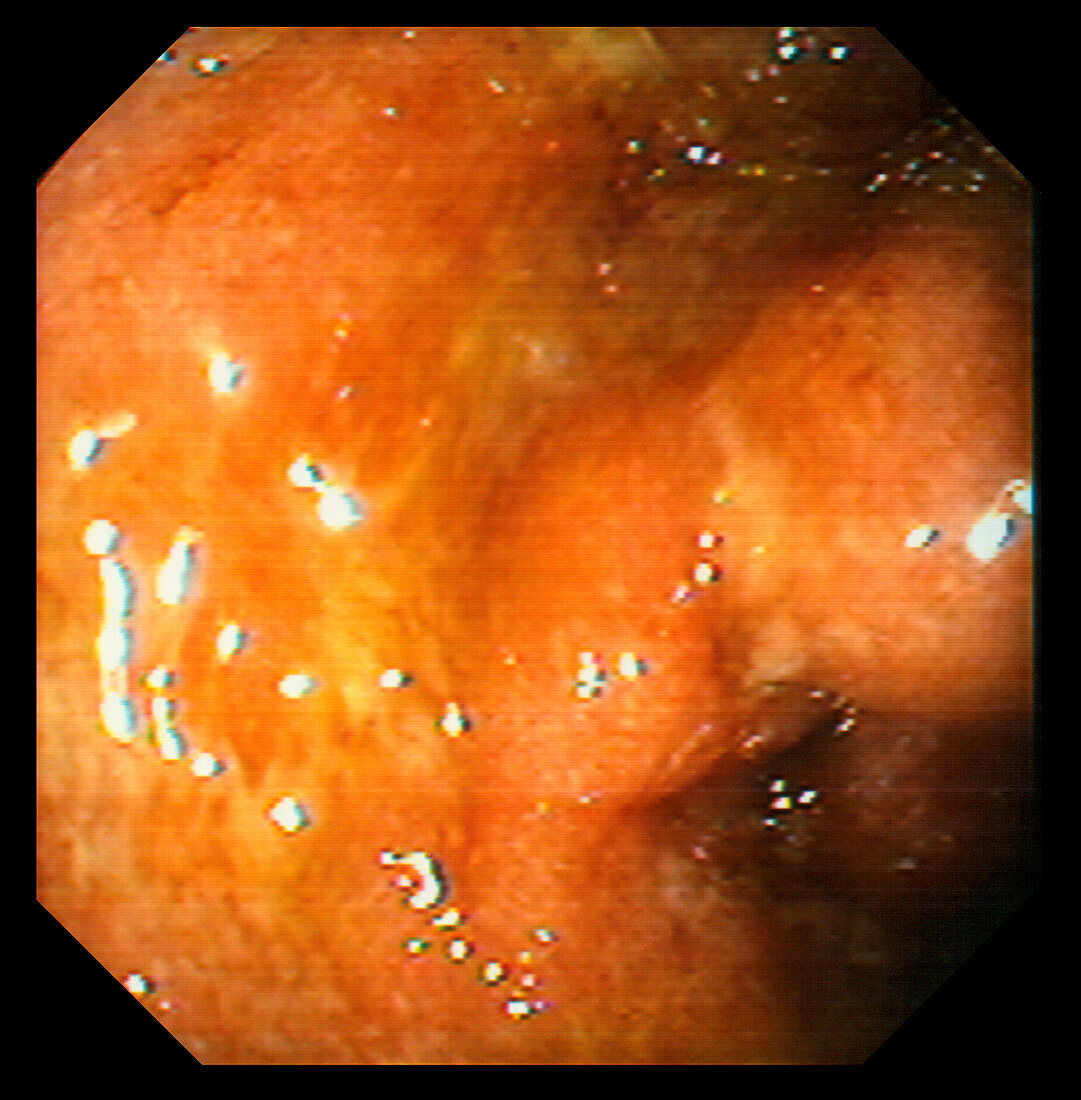 Ulcerative colitis