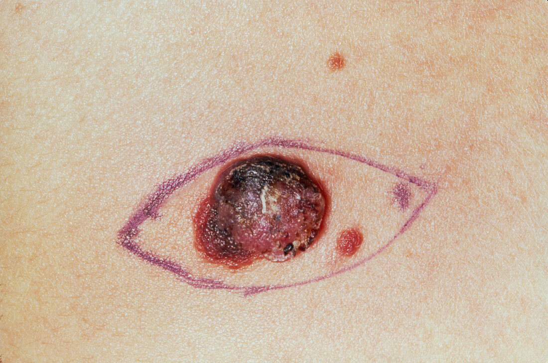 Close up of a malignant melanoma before excision