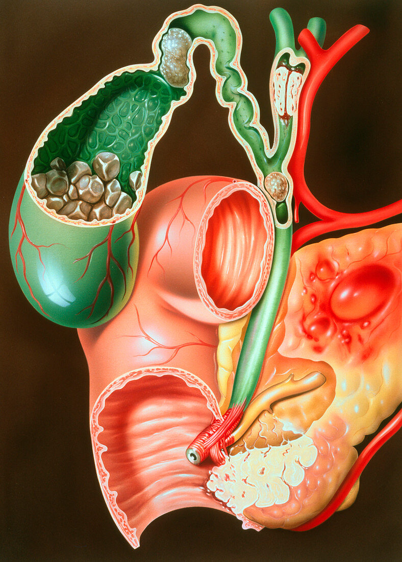 Illustration of pancreatic carcinoma