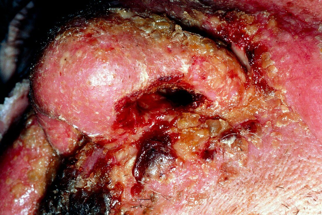 Squamous cancer of nose 2 weeks post radiotherapy