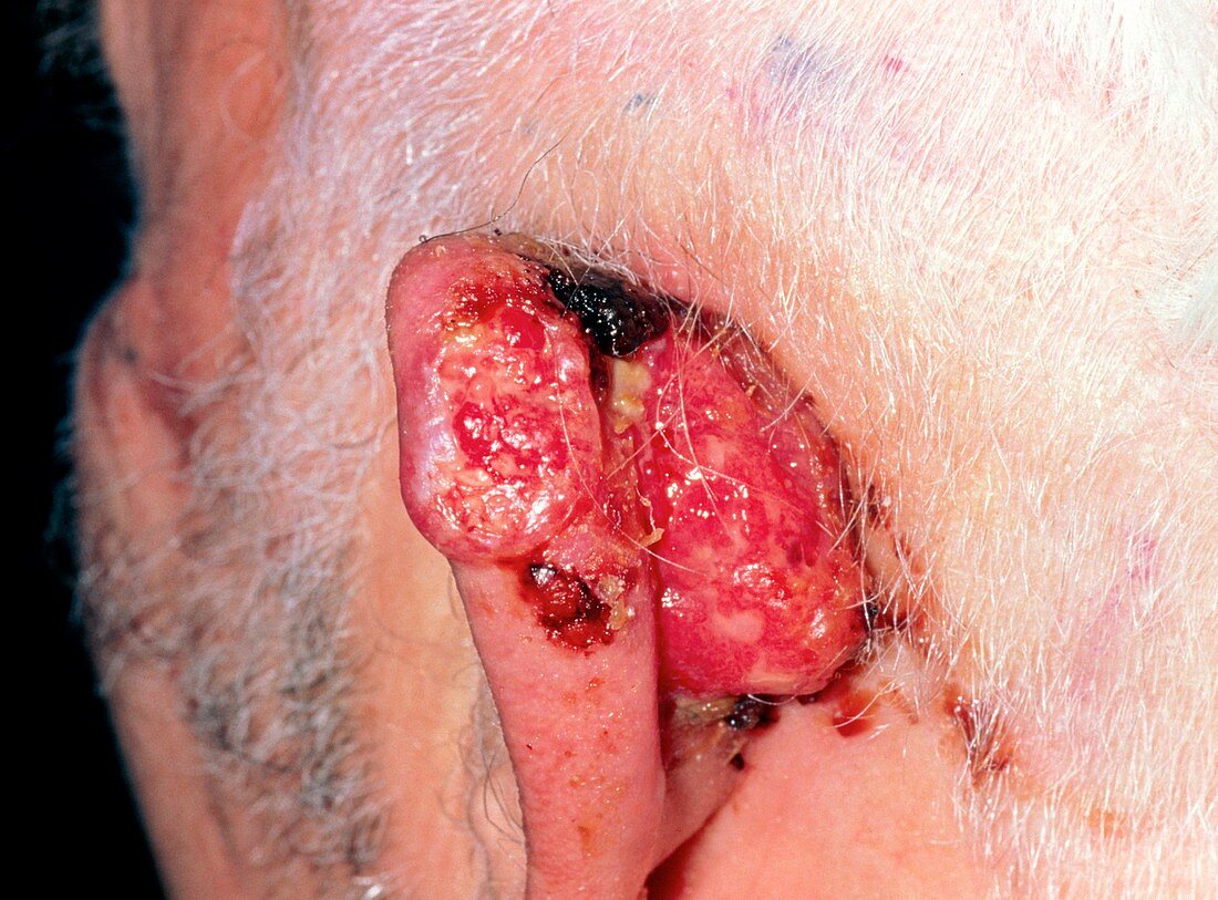 A squamous cell carcinoma of the ear