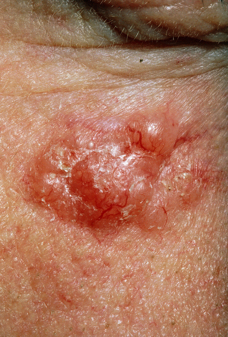 Basal cell carcinoma on a patient's cheek