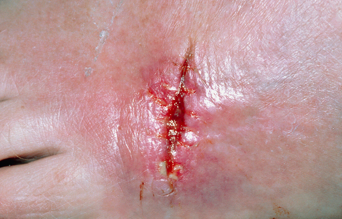 Infected wound after excision of rodent ulcer