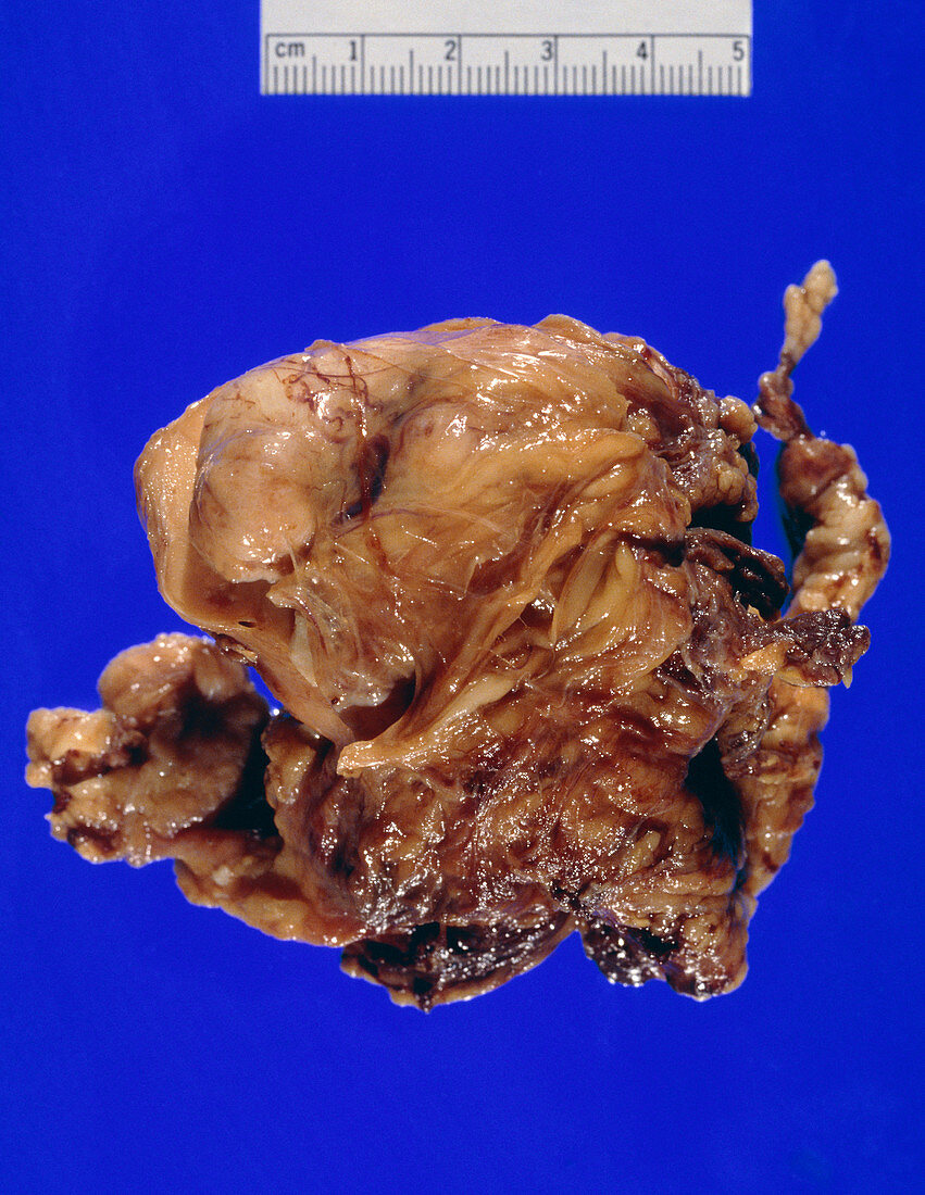 Gross specimen of thymus gland with tumour