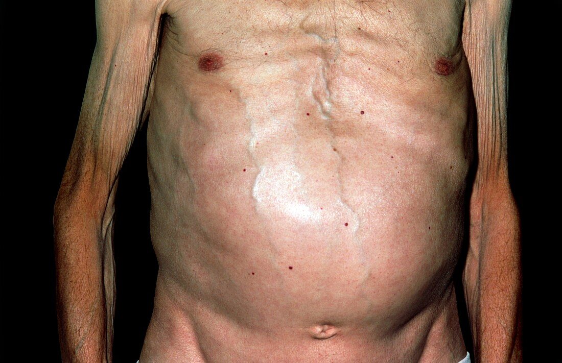 Swollen abdomen due to spreading skin cancer