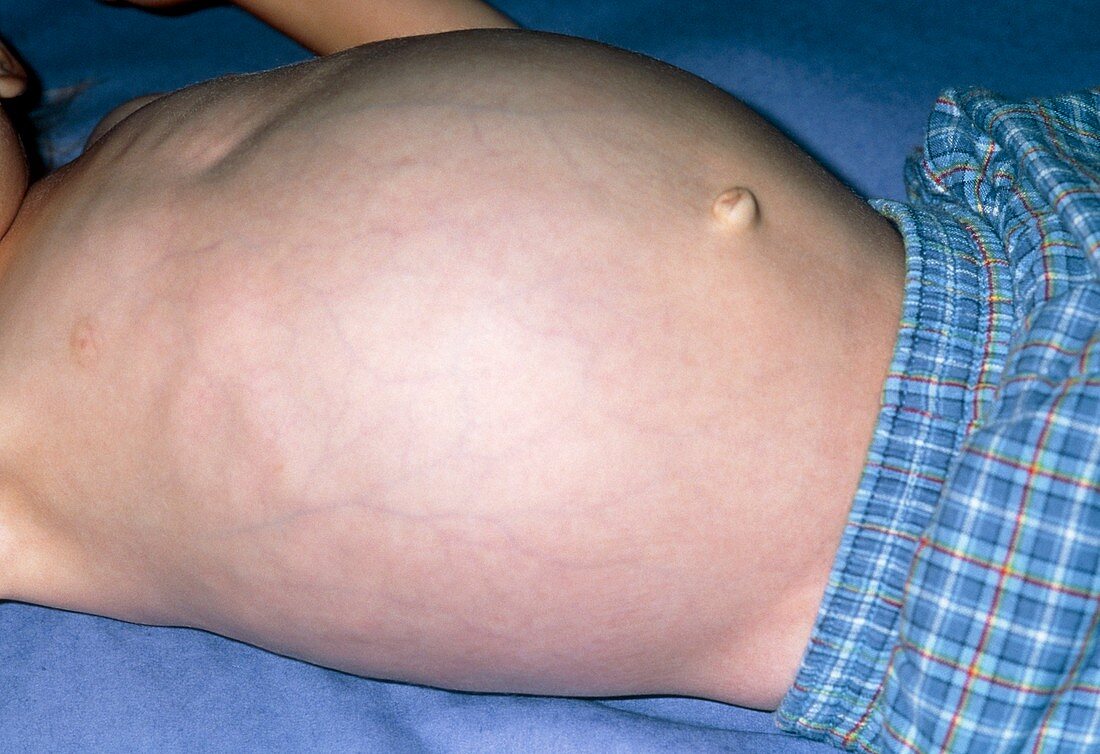Swollen abdomen due to hepatomegaly from cancer