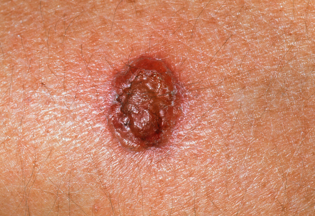 Basal cell carcinoma one week after cryosurgery