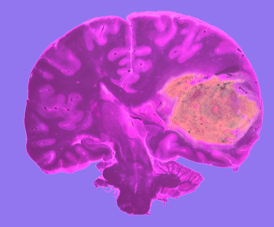 Brain tumour