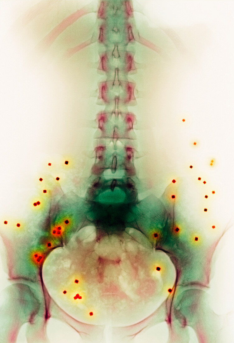Constipation markers,X-ray