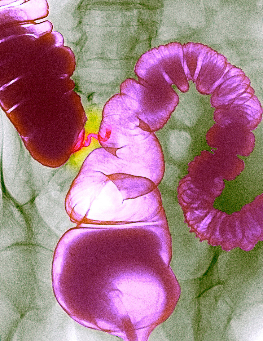 Colonic spasm,X-ray