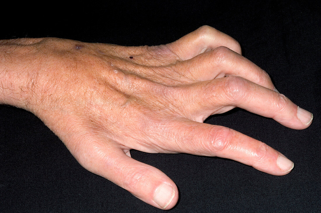 Claw hand due to nerve compression