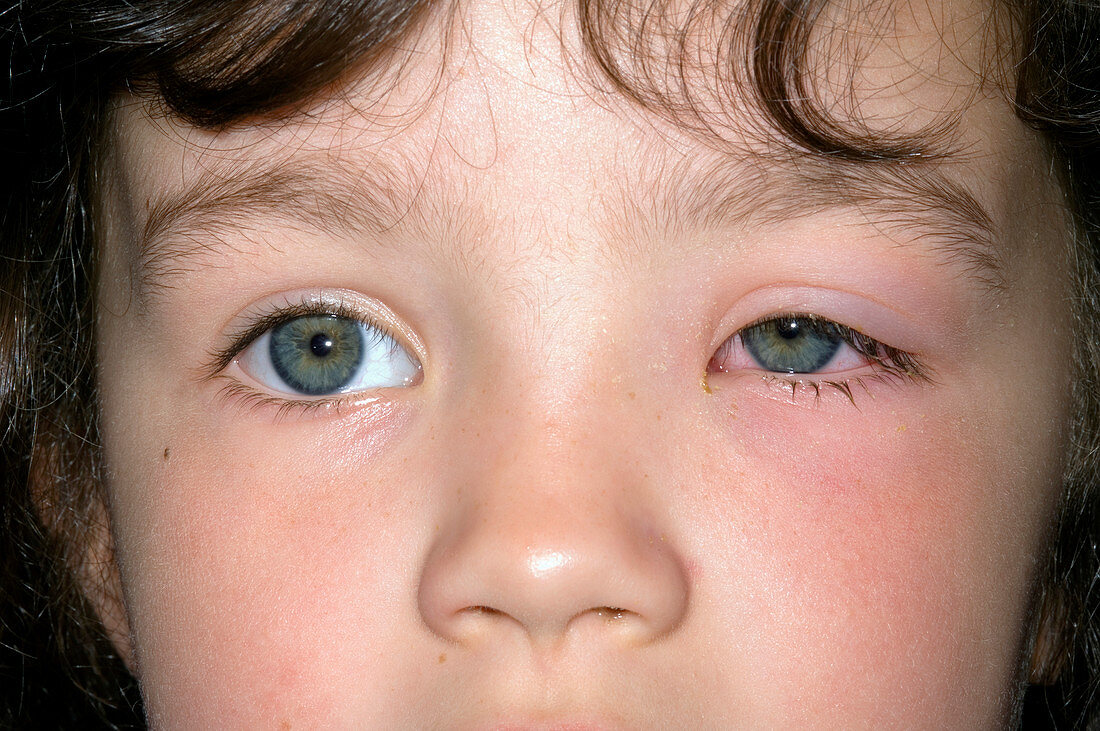 Periorbital cellulitis