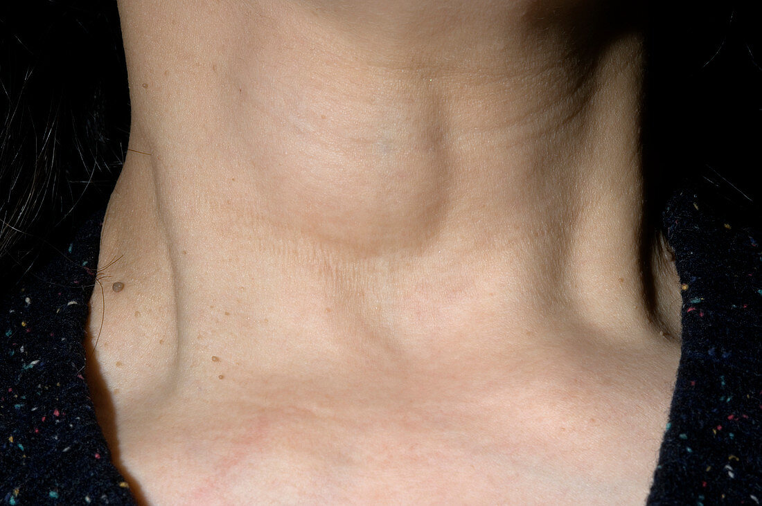Thyroid cyst