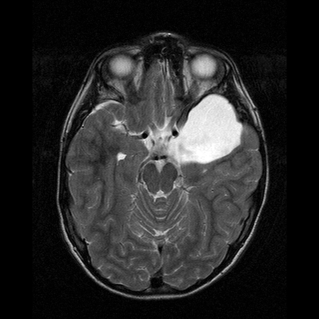 Arachnoid Cyst,MRI scan
