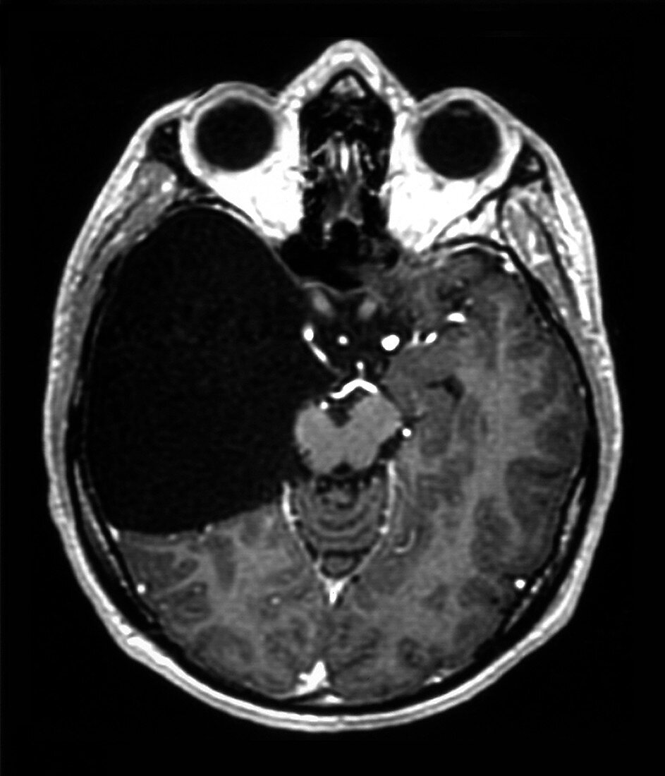 Arachnoid cyst,MRI scan