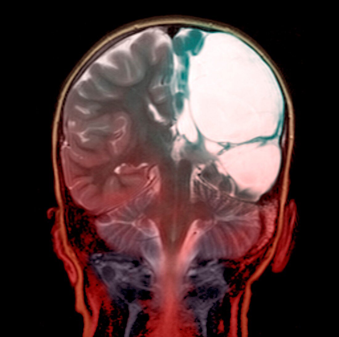 Cerebral palsy,MRI scan