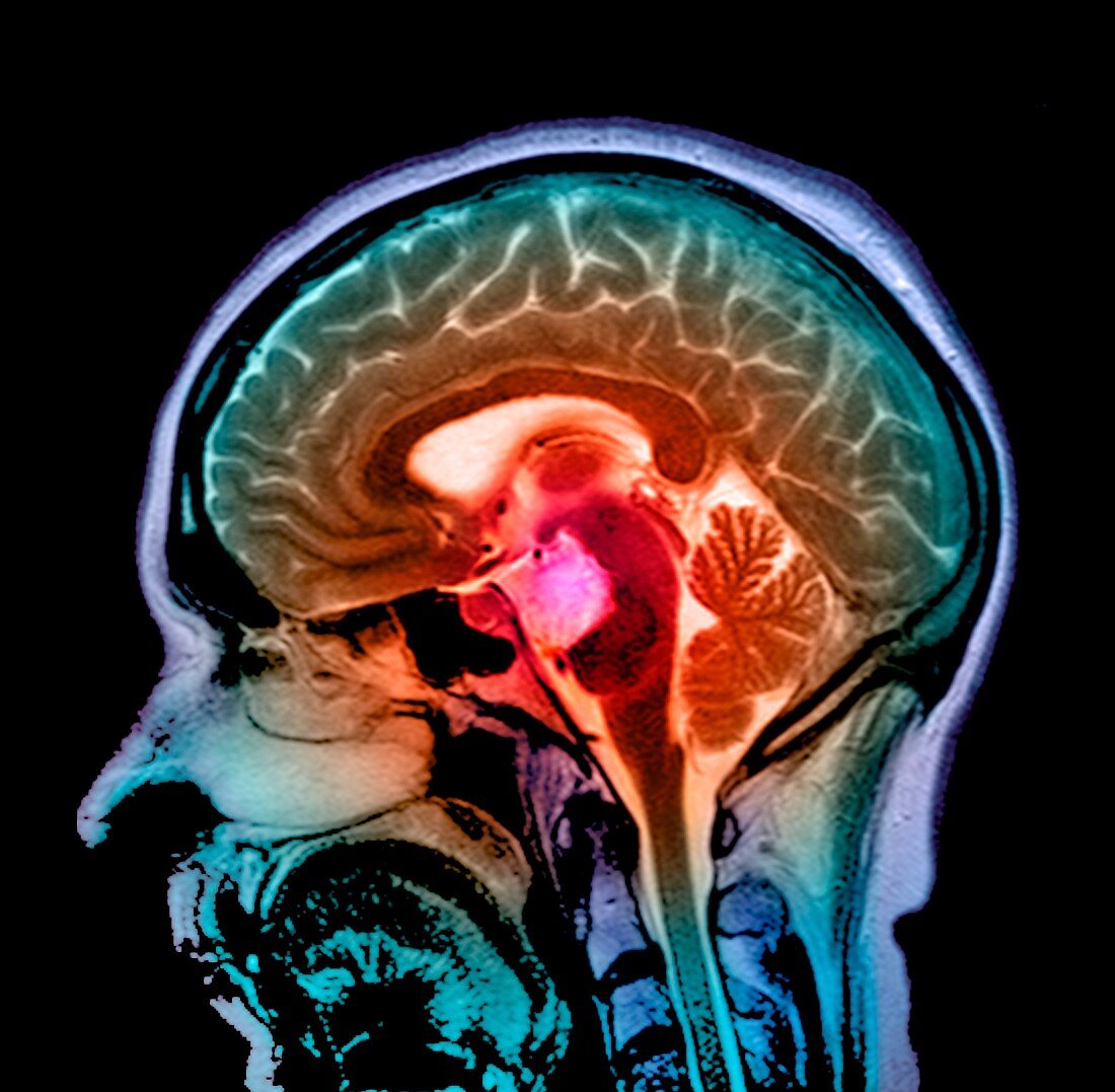 Brain cyst,MRI scan