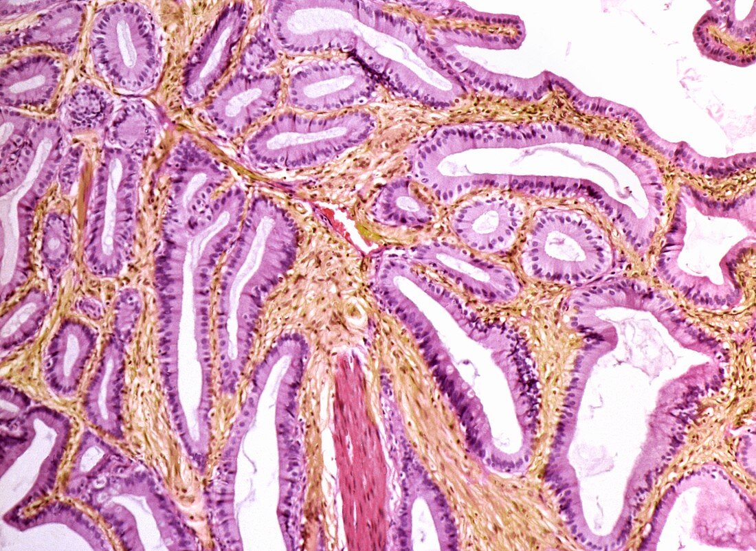 Inflamed gall bladder,light micrograph