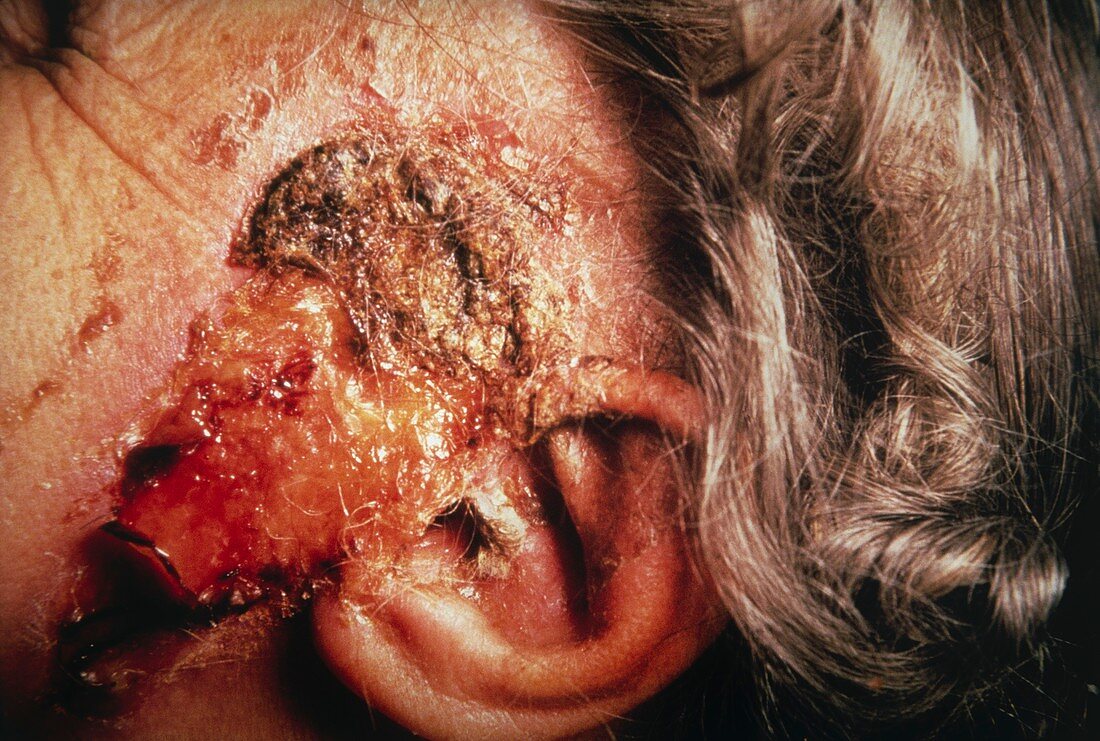 Clinical photo of squamous carcinoma of skin