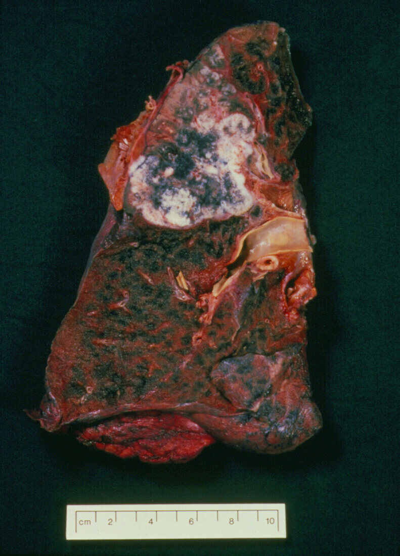 Post-mortem cancerous lung of cigarette smoker