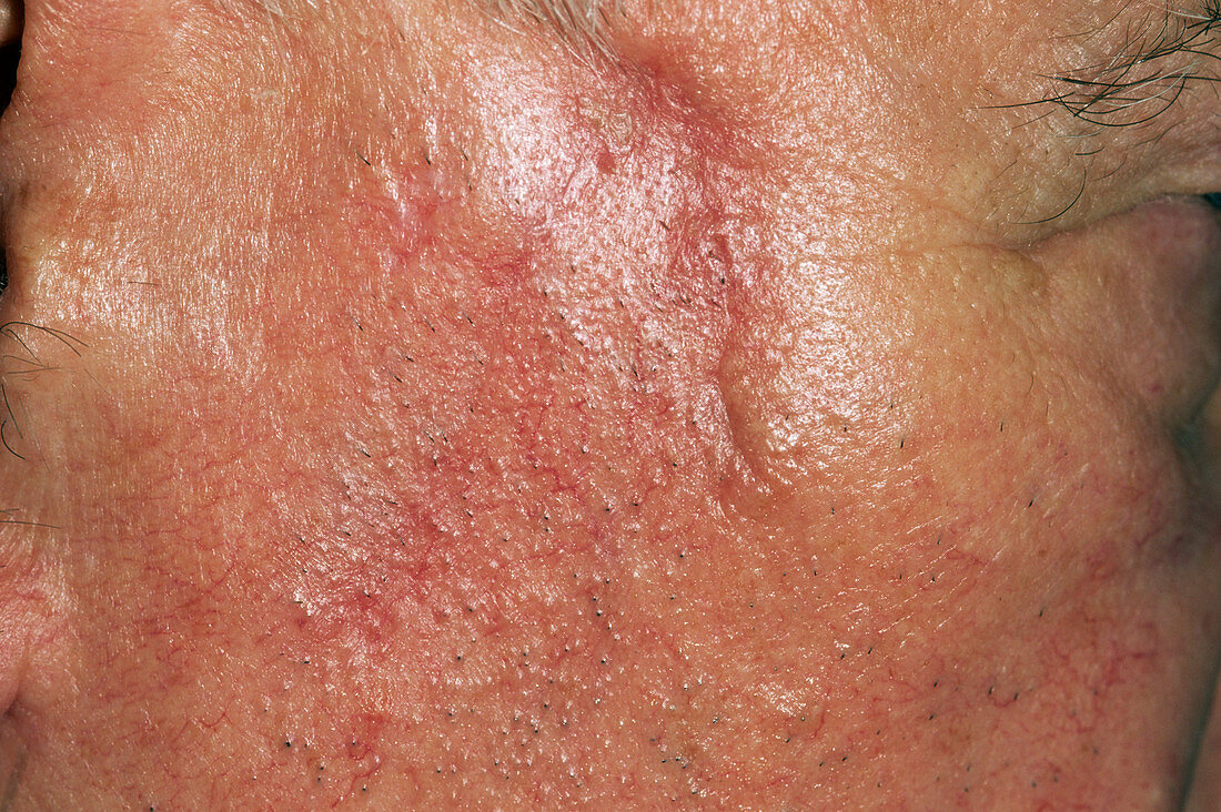 Skin cancer scar