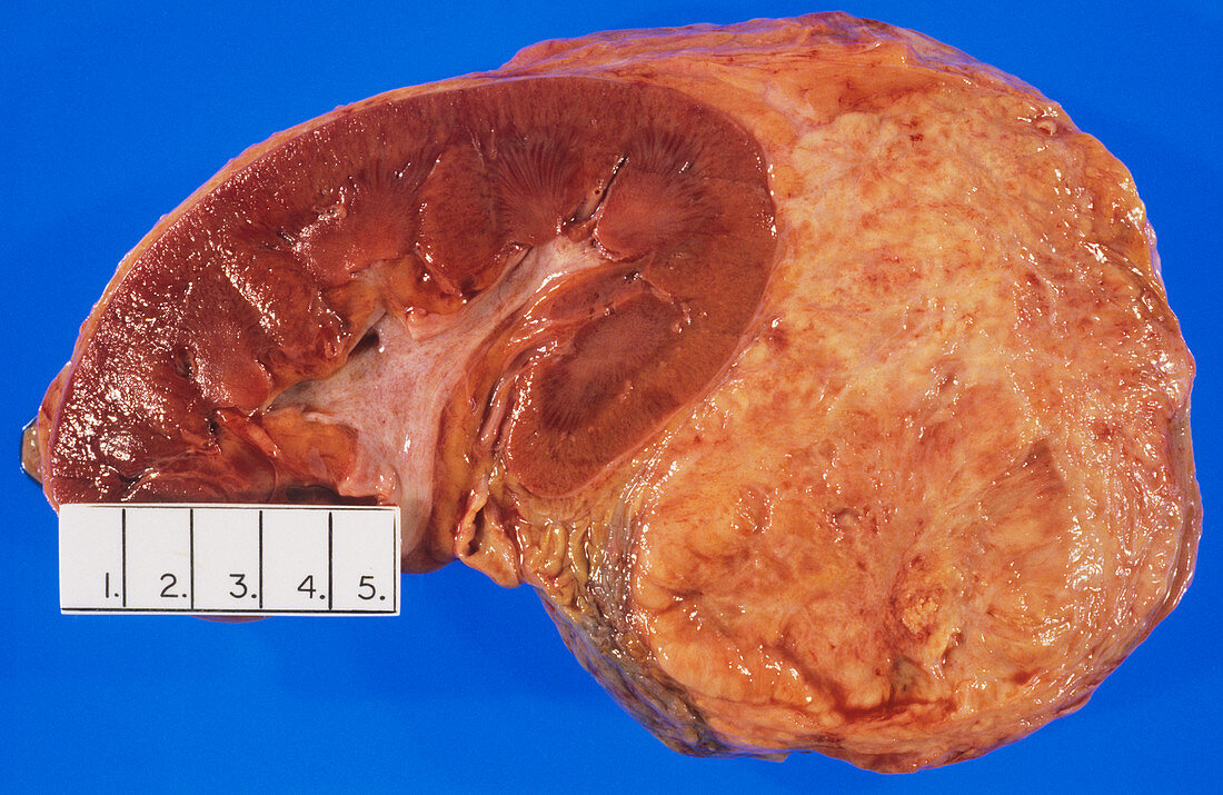 Secondary adrenal cancer
