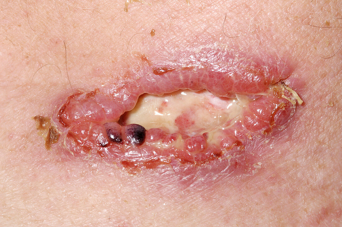 Infected skin cancer scar