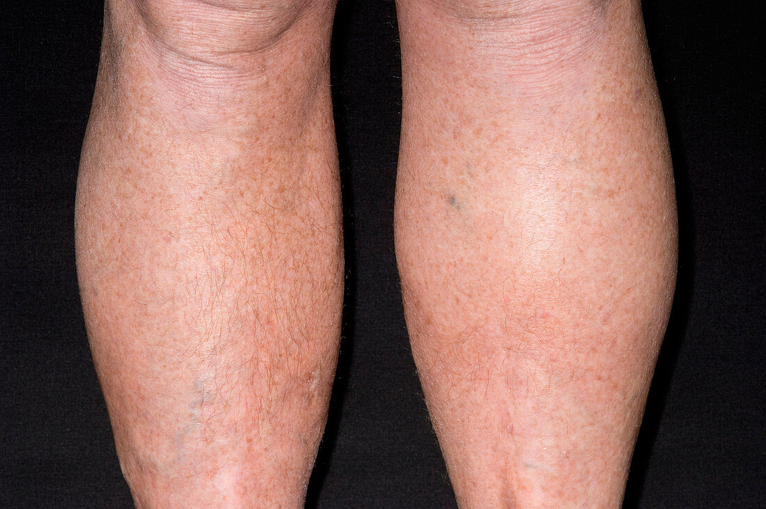 Lymph swelling in Hodgkin's disease