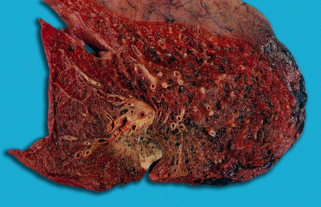 Squamous cell carcinoma lung cancer