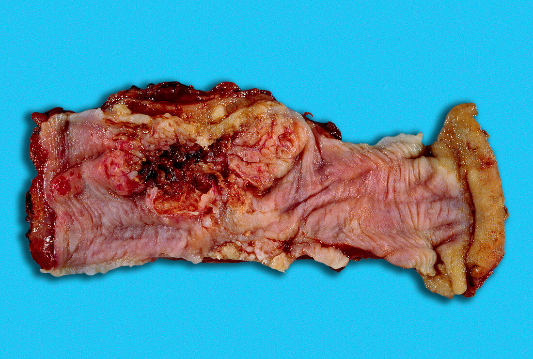 Cancer of the oesophagus