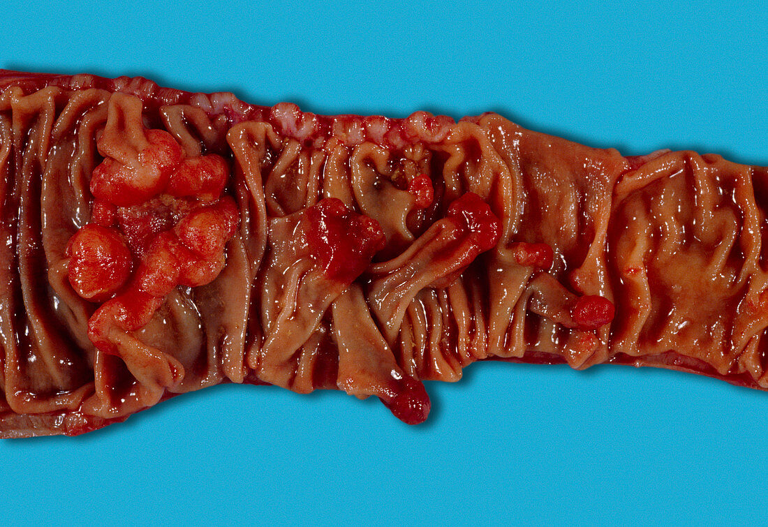 Cancerous polyps of the colon