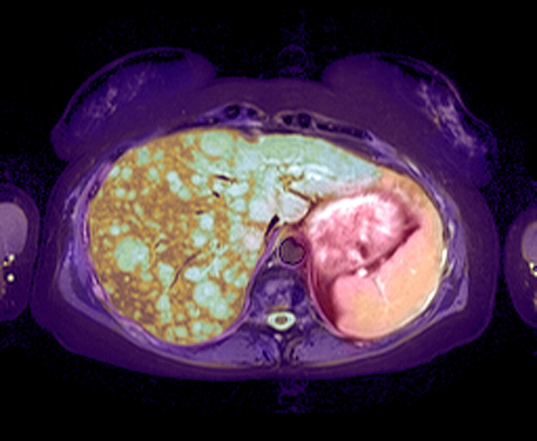 Liver cancer,MRI scan