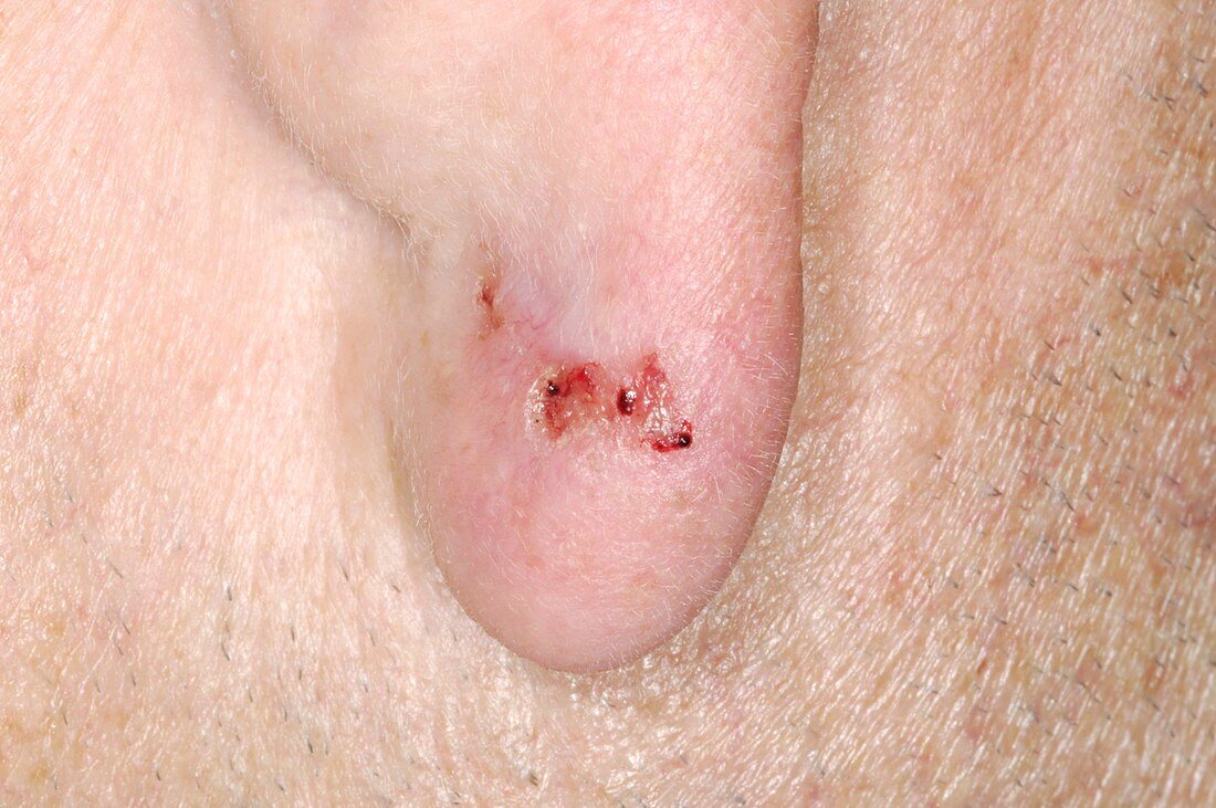 Skin cancer on ear,basal cell carcinoma