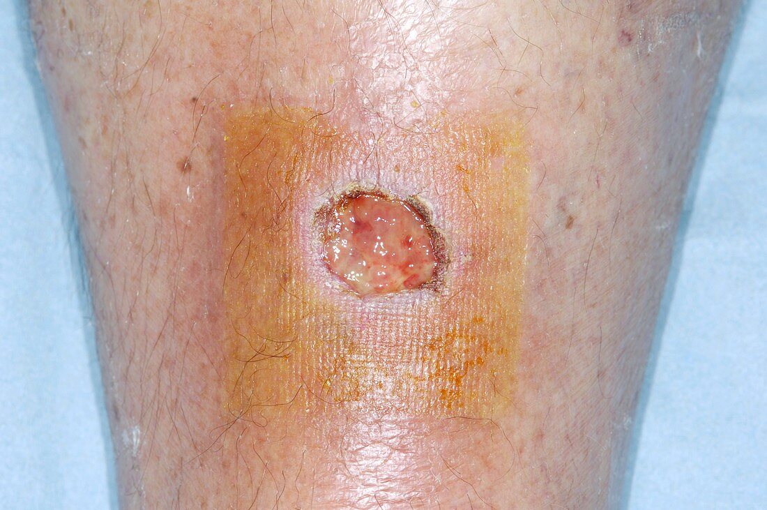 Failed skin graft for skin cancer