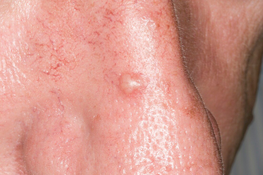 Basal cell carcinoma of the nose
