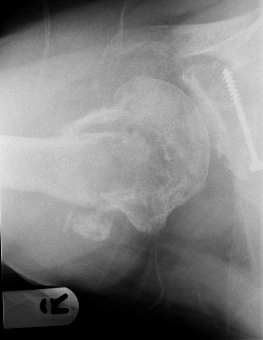Bone cancer,shoulder X-ray