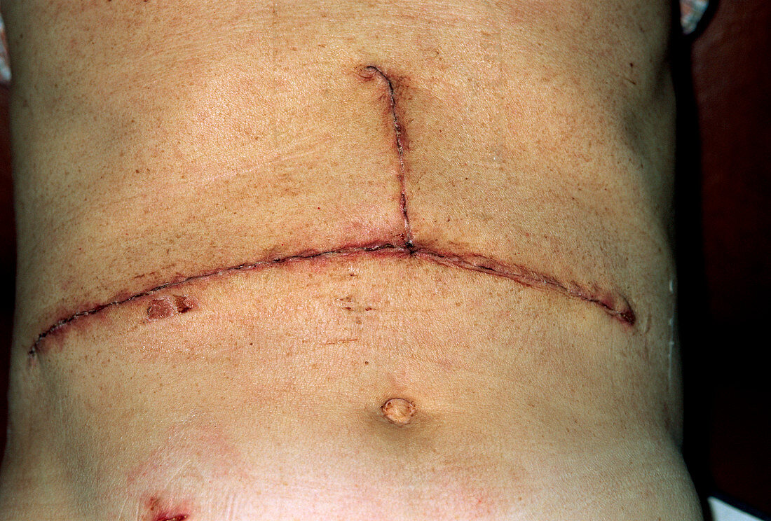 Scar from liver cancer surgery