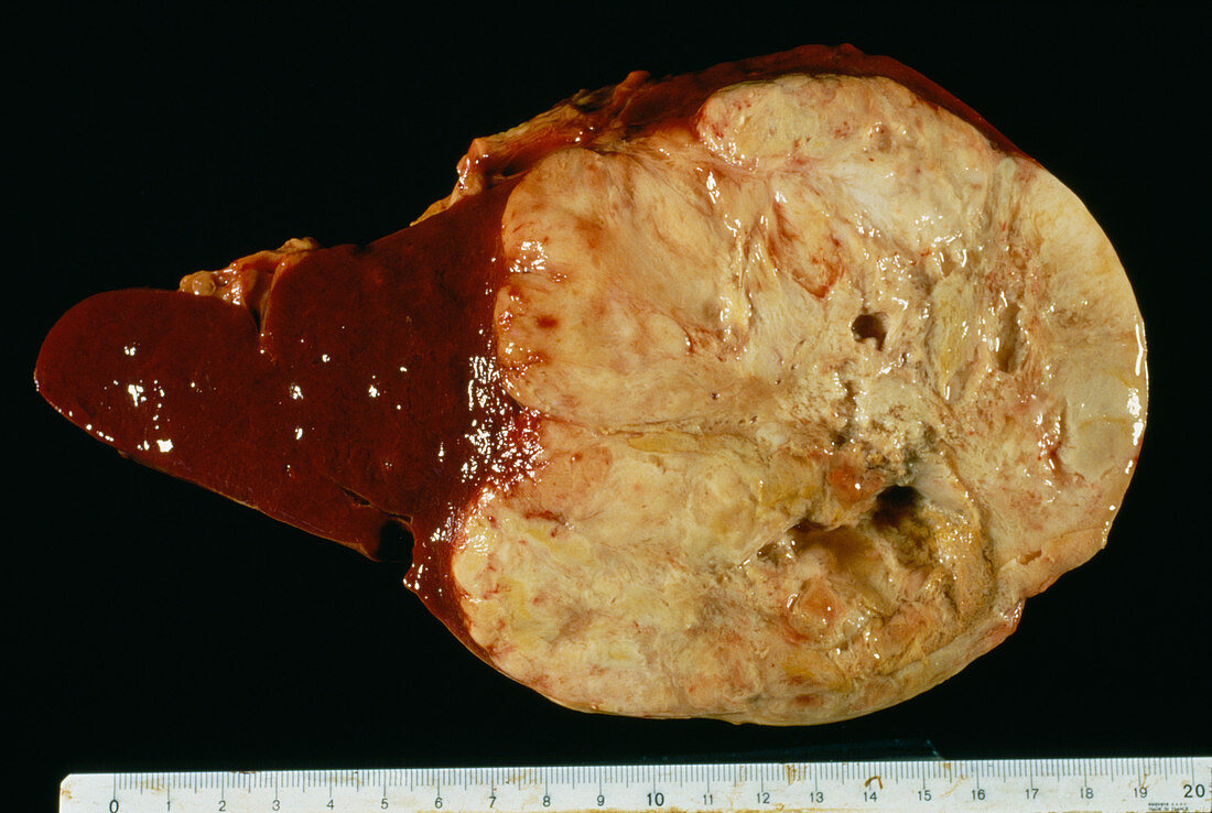 Spleen cancer,gross specimen