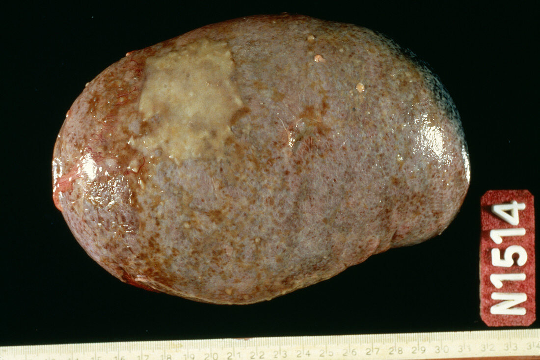 Waldenstrom's disease spleen