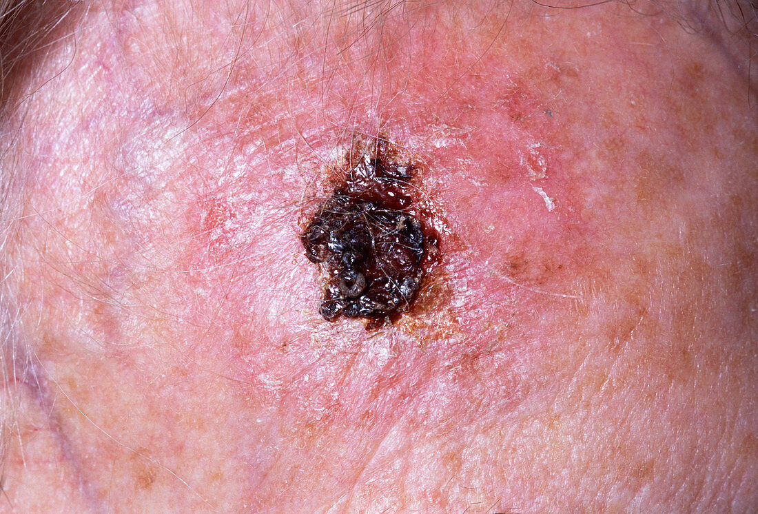 Skin cancer