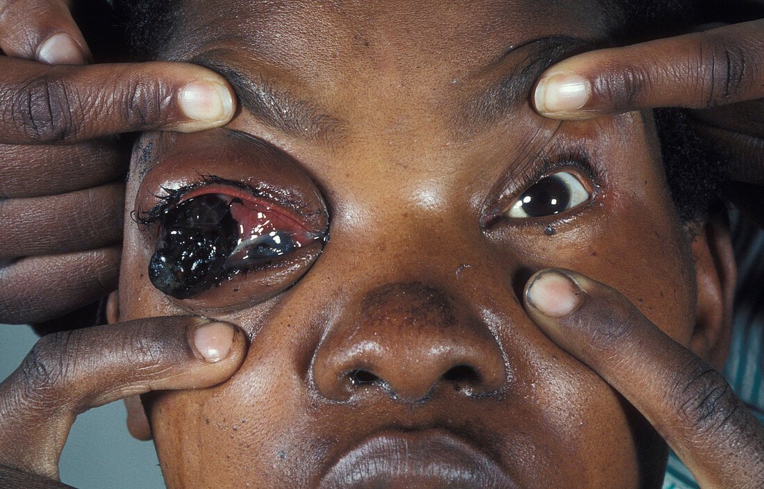 Eye cancer