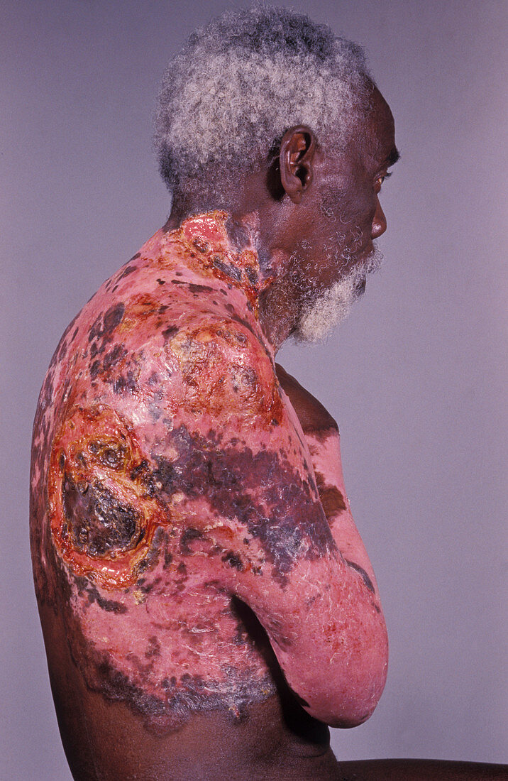 Infected skin cancer