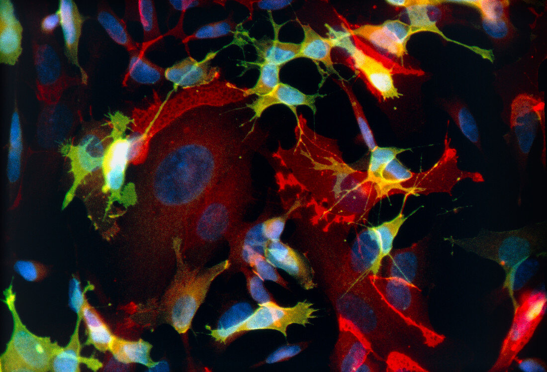 Immunofluorescent LM of neuroblastoma cancer cells