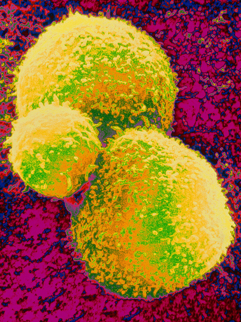 Coloured SEM of lymphocyte attacking cancer cells