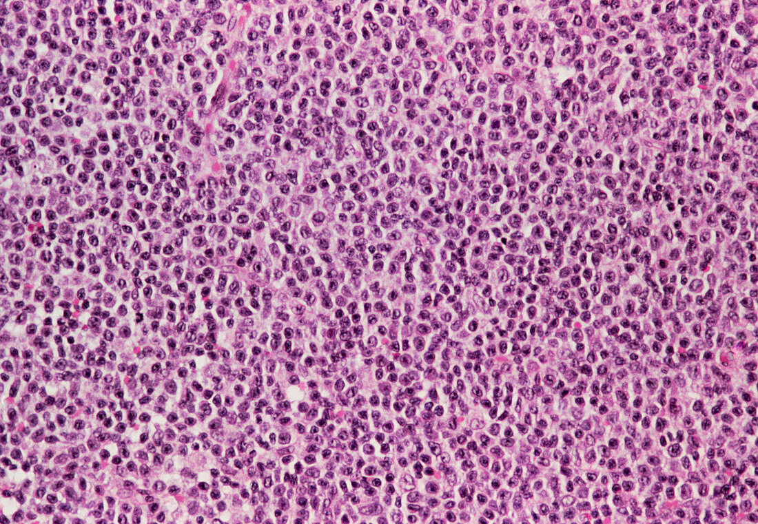 Coloured LM of high grade non-Hodgkin's lymphoma