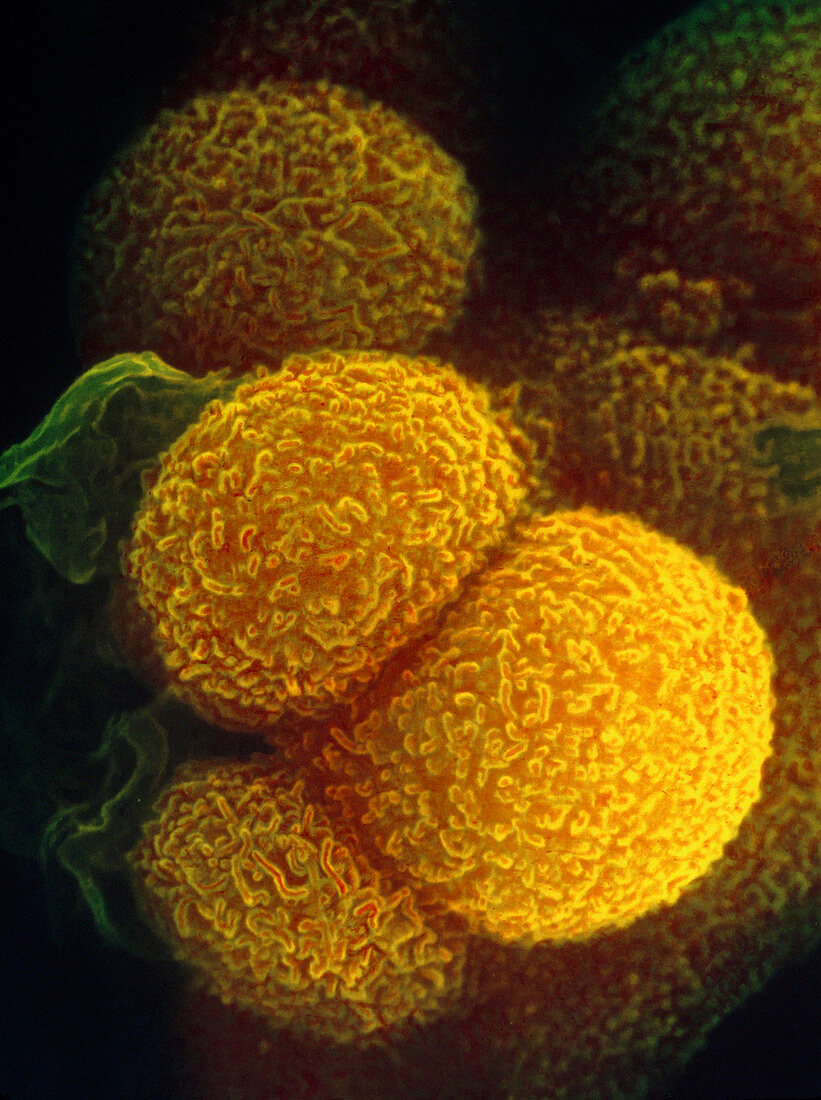 Coloured SEM of colon carcinoma (cancer) cells