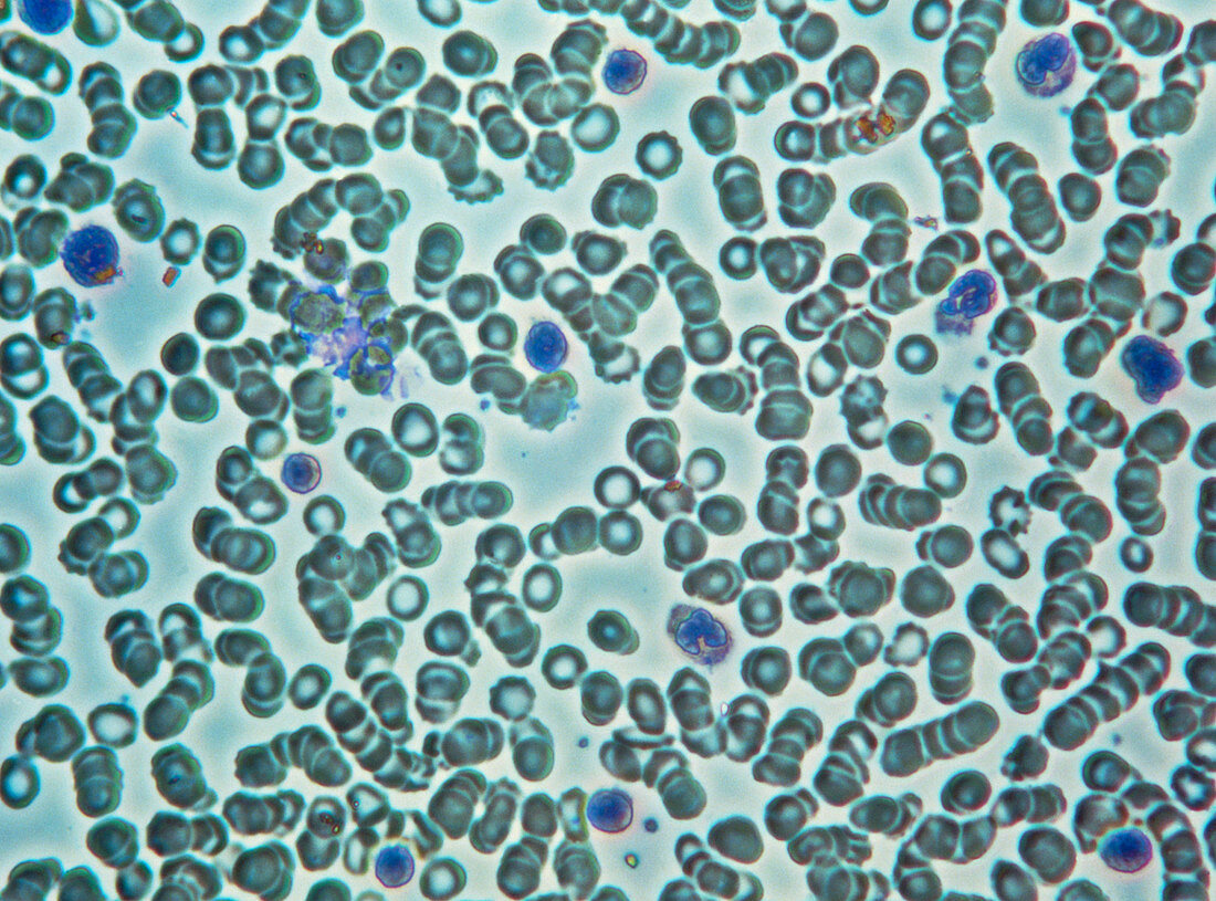 Leukaemia blood cells