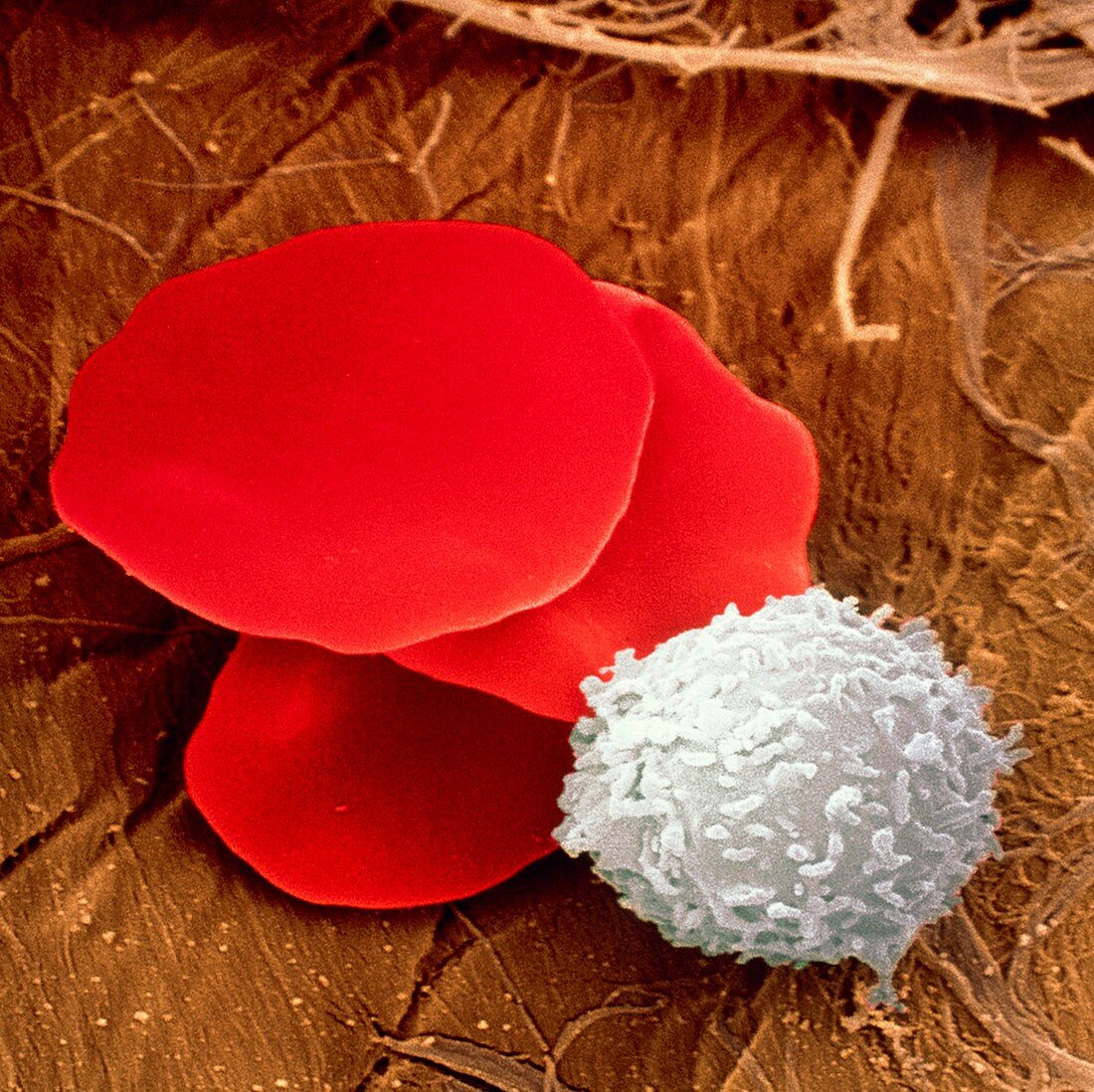 Leukaemia blood cells,SEM