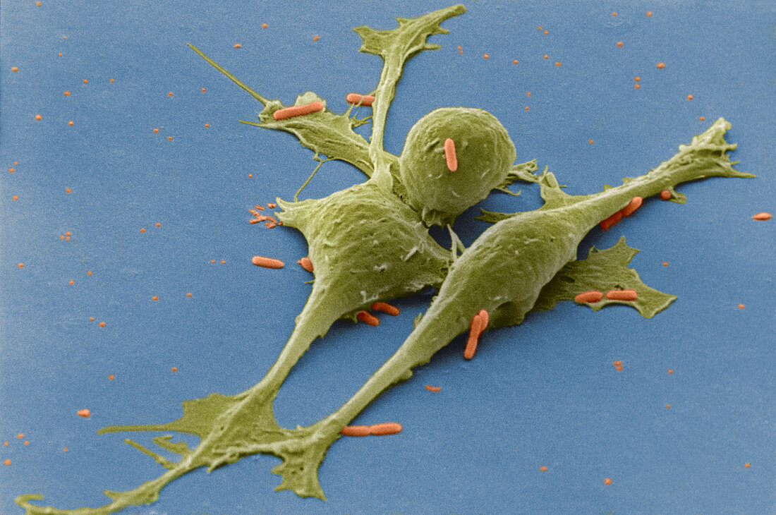 Smooth muscle cancer cells,SEM